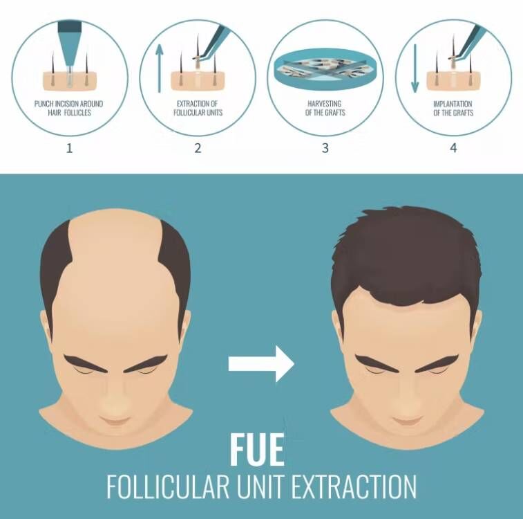 ماكينة زرع شعر من FUE-Micro Mo - مراجعة Hair Care Products وسعره